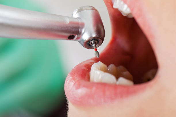 Best Emergency Root Canal Treatment in Meadow Glade, WA